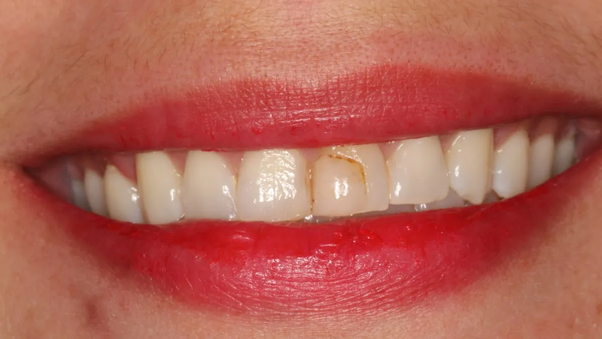 Antes: sonrisa con un empaste manchado y bordes desgastados