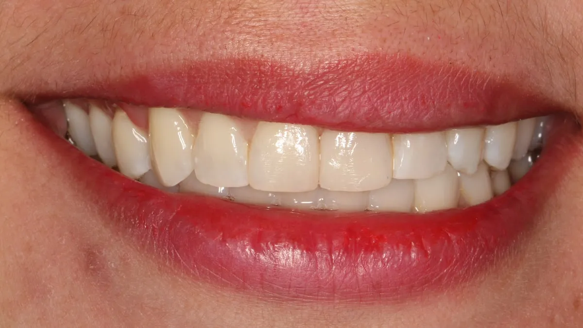 Después: sonrisa con carillas de composite, de forma y color uniformes