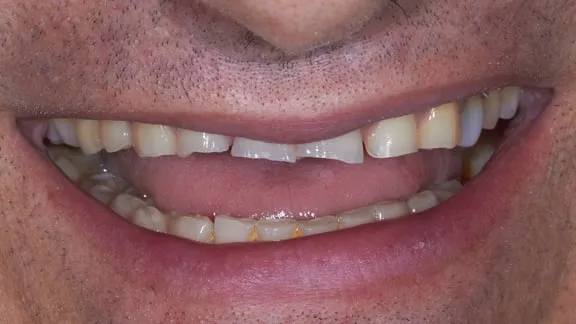 Antes: sonrisa con los incisivos de arriba muy desgastados y los bordes rotos