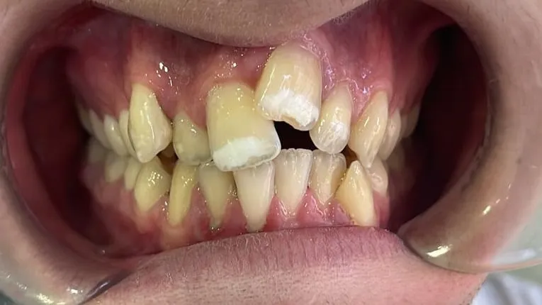Antes: dientes apiñados y un incisivo central roto