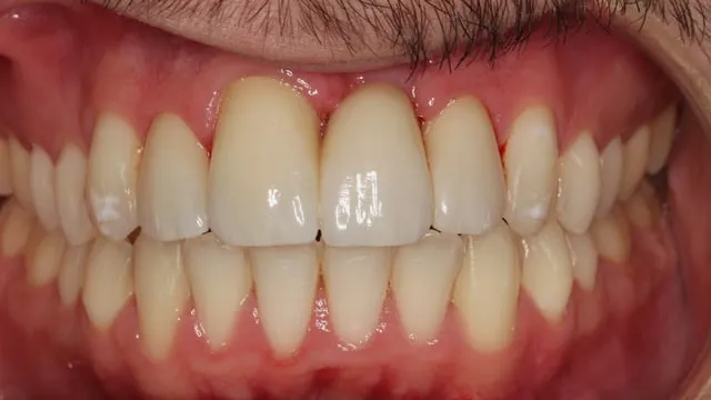 Después: dientes alineados, con un implante y coronas de circonio