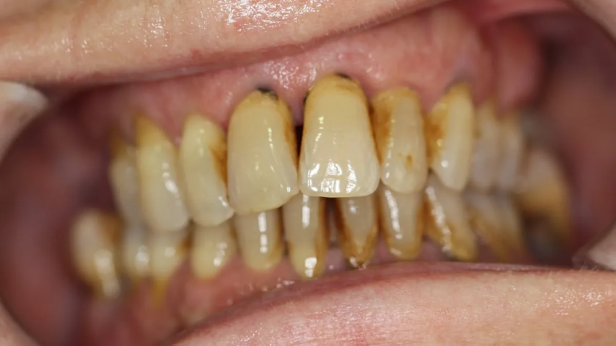 Antes: dientes muy deteriorados y manchados en las dos arcadas