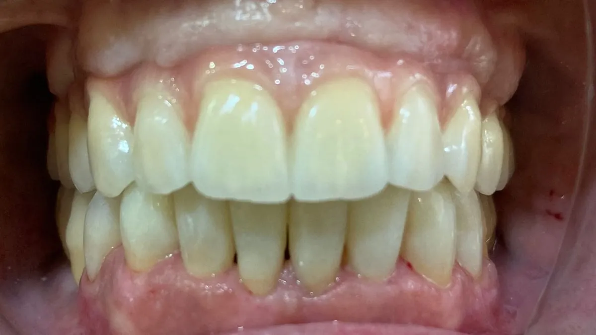 Después: coronas de circonio sobre implantes arriba y carillas de composite abajo