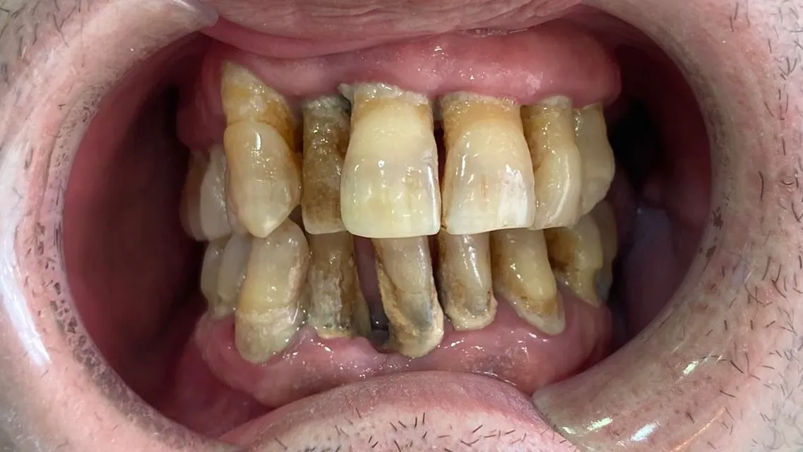 Antes: dientes manchados y separados por una enfermedad periodontal avanzada