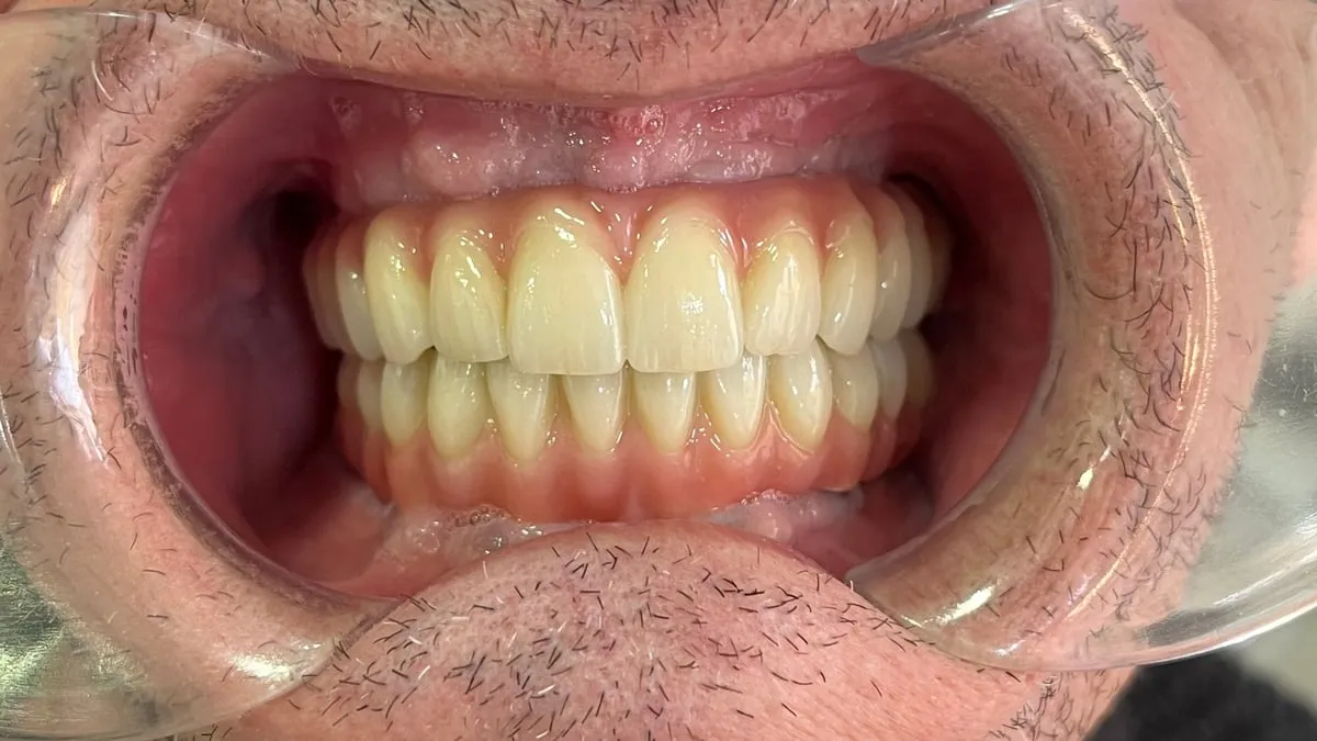 Después: dientes fijos sobre implantes en las dos arcadas