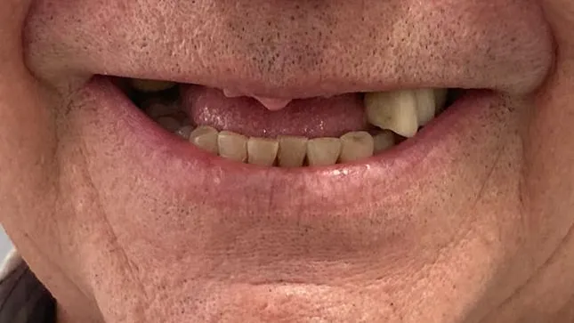 Antes: sonrisa con un puente antiguo y los dientes de arriba fracturados