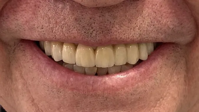 Después: sonrisa completa con dientes fijos sobre implantes