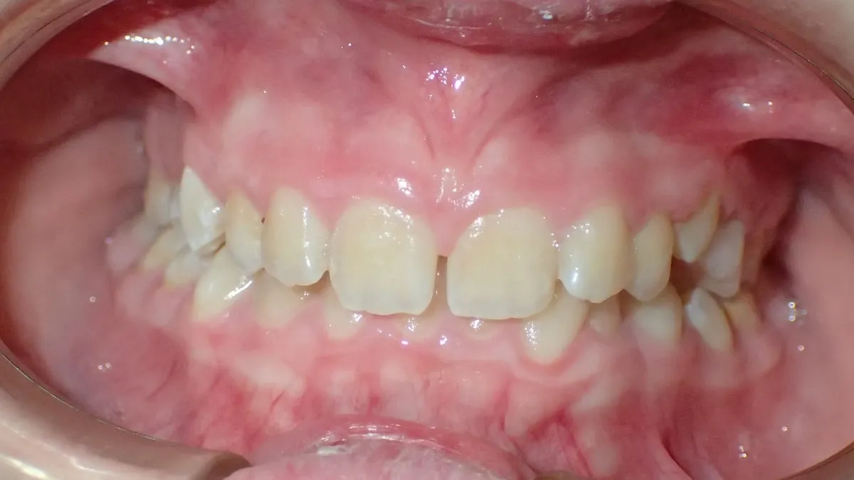Antes de la ortodoncia: dientes apiñados y sobremordida