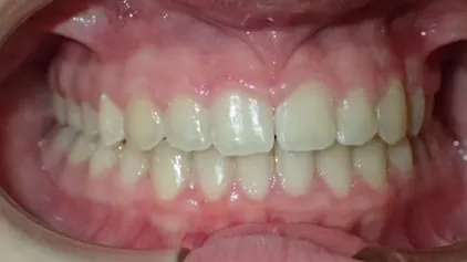 Después de la ortodoncia: dientes alineados