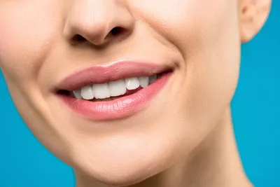 Sonrisa con carillas dentales