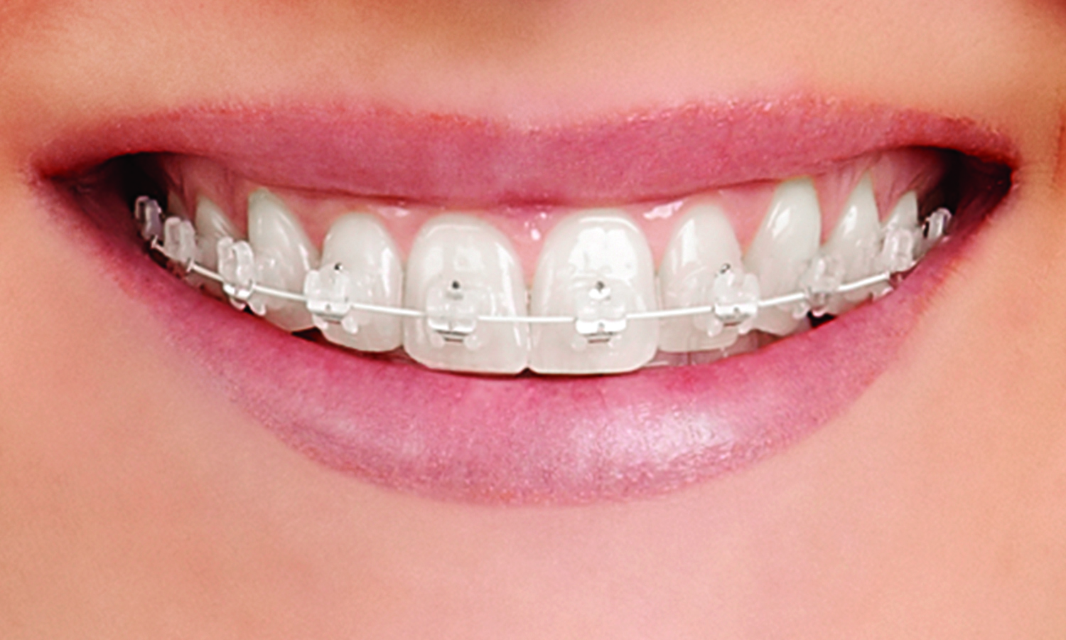 Brackets Autoligado