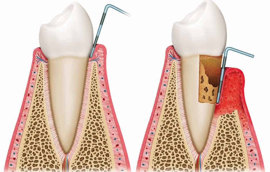 Periodoncia